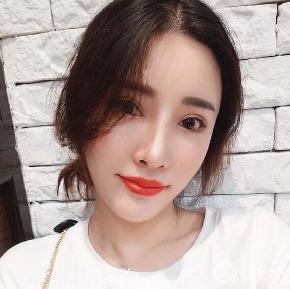 銀川崔大夫博士麗朱杰自體脂肪豐面頰恢復(fù)記錄附對比圖片