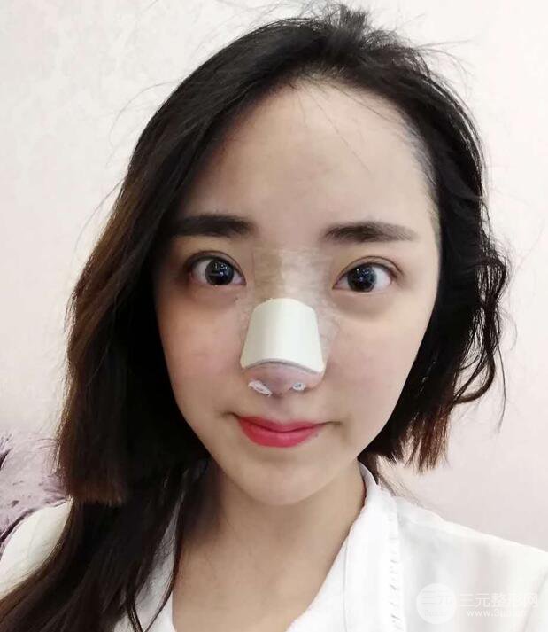 東莞寶格麗韋文奇隆鼻整形果圖分享，對(duì)比曝光