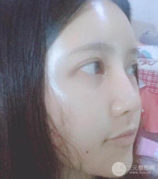 宜昌美岸醫(yī)療美容李英華自體脂肪面部填充怎么樣？真人日記曝光