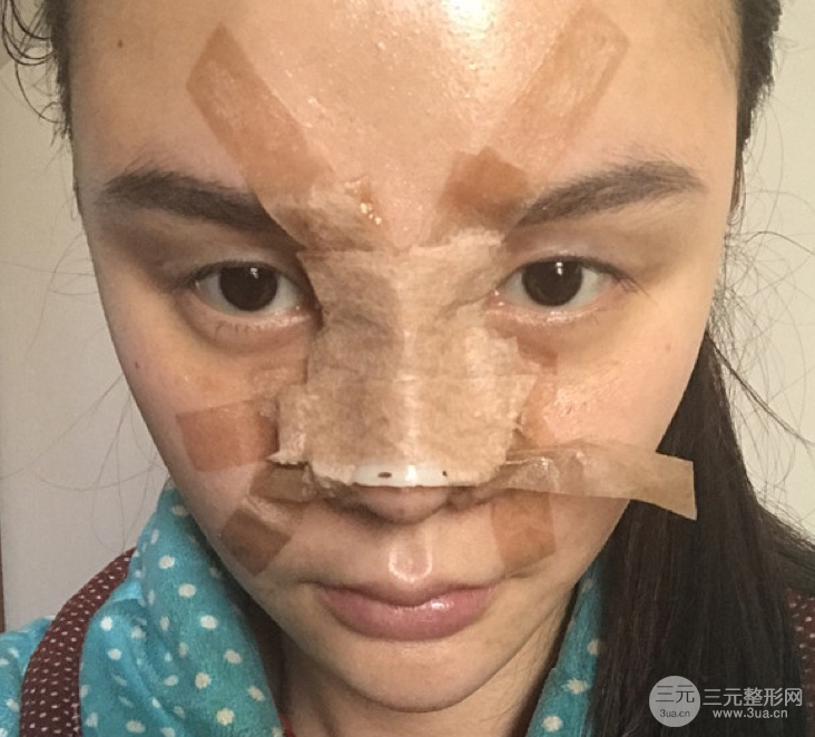 隆鼻整形三個月記錄，恢復(fù)后立體度不輸外國人