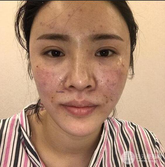 銀川崔大夫博士麗朱杰自體脂肪豐面頰恢復(fù)記錄附對比圖片