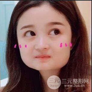 誰說臉大沒未來，下頜角整形后我輕松美出新高度