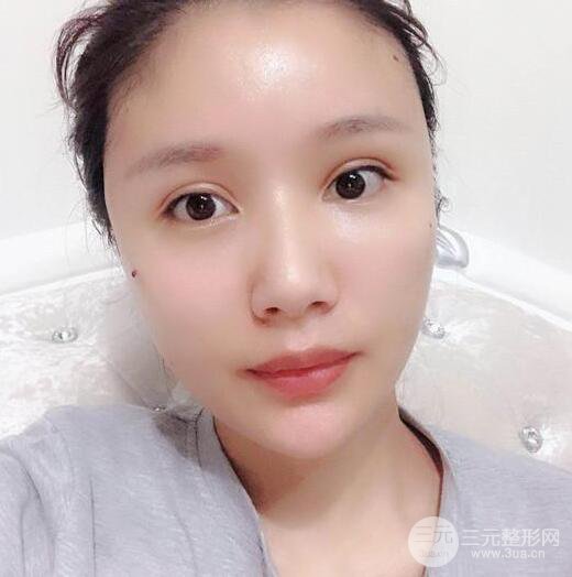 辣媽做了自體脂肪填充全臉，對(duì)比圖分享