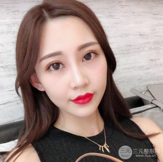割雙眼皮兩個月是啥樣，妹子公開恢復(fù)記錄