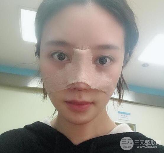 自體軟骨隆鼻恢復(fù)記錄，附對(duì)比圖片