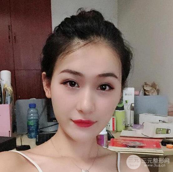 泉州億星醫(yī)療美容沈文鑫自體脂肪填充面部真人反饋