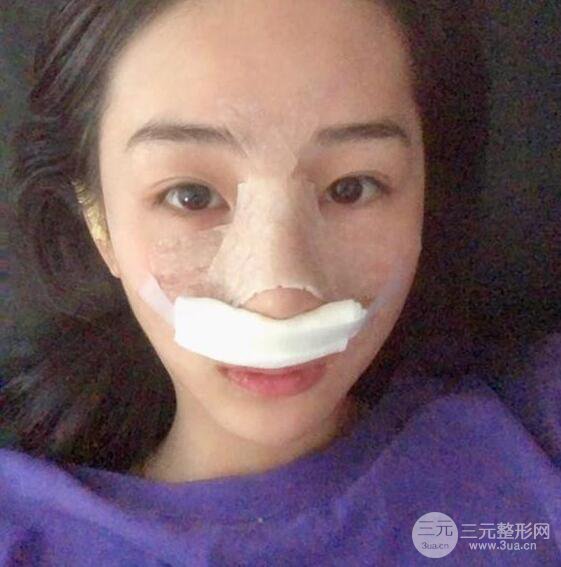 洛陽愛尚醫(yī)療美容王廷金隆鼻整形果圖，恢復(fù)后有點像張鈞甯