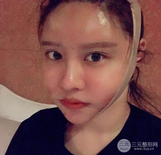 減肥太辛苦了，我還是做個(gè)面部吸脂來逆襲