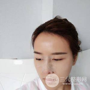 自體脂肪面部填充恢復(fù)自然果圖