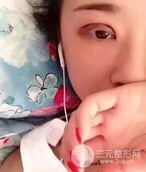 切開(kāi)雙眼皮15天果圖