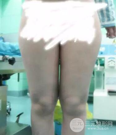腿部吸脂親身經(jīng)歷