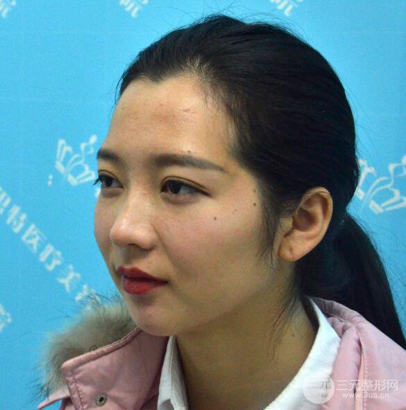 長得太著急是怎樣一種體驗？妹子血淚分享自體脂肪填充詳細(xì)部年輕化經(jīng)驗