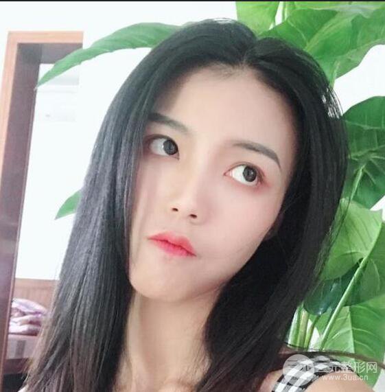 銀川崔大夫博士麗朱杰硅膠隆鼻恢復(fù)圖，輕松get精致臉