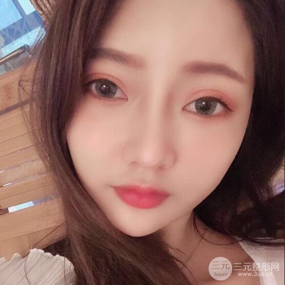 只是做了隆鼻整形改變居然辣么大，快來看看我的隆鼻整形恢復日記叭