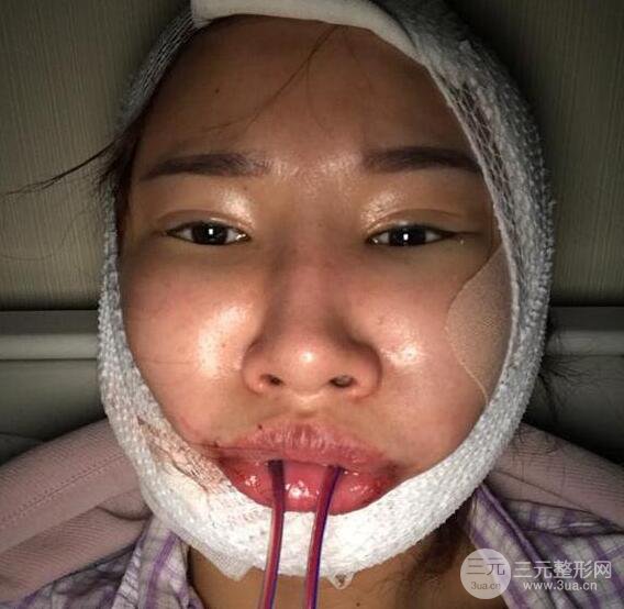 去下頜角+顴骨內(nèi)推手術(shù)三個月記錄，看大臉妹如何逆襲