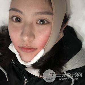 面部吸脂100天恢復(fù)果對比圖