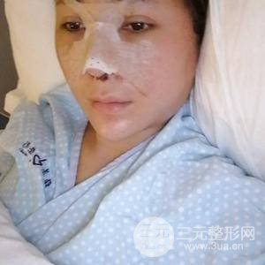 進(jìn)口假體+肋軟骨墊鼻尖三個(gè)月果恢復(fù)對比圖