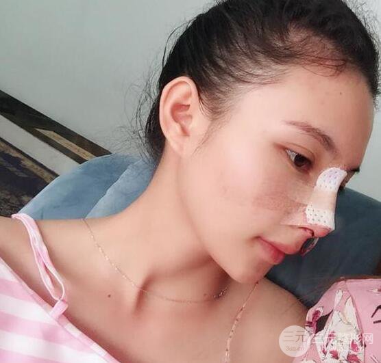 妹子做了隆鼻整形后竟變混血臉，來看看像baby還是娜扎