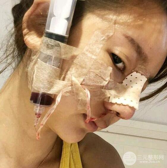 只是做了隆鼻整形改變居然辣么大，快來看看我的隆鼻整形恢復日記叭