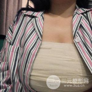 假體隆胸三個月恢復圖
