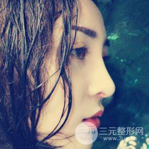 進(jìn)口假體+肋軟骨墊鼻尖三個(gè)月果恢復(fù)對比圖