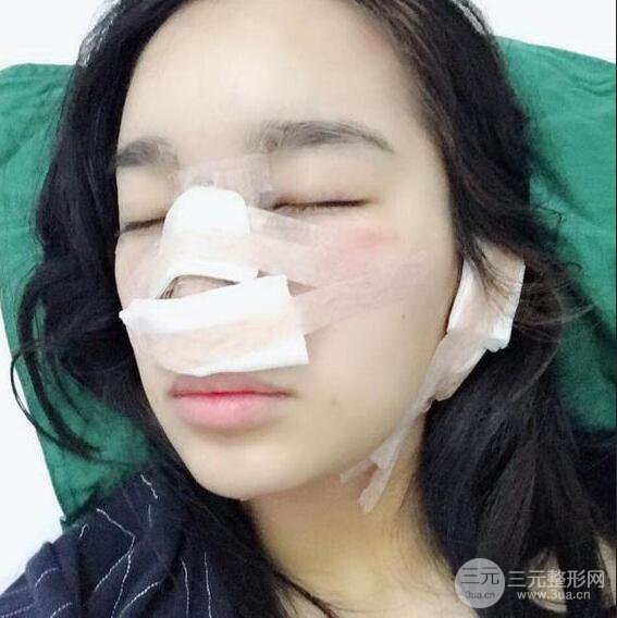 隆鼻整形術前術后對比照曝光，附經(jīng)驗分享及心得體會