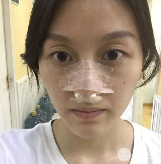 做了“埋埋蛋白線.提升+隆鼻整形”，恢復后老公說很沒有降低風險感