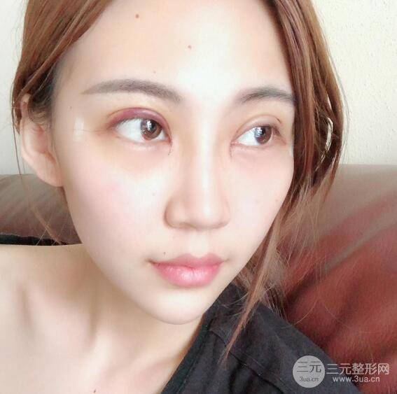 割雙眼皮兩個月是啥樣，妹子公開恢復(fù)記錄