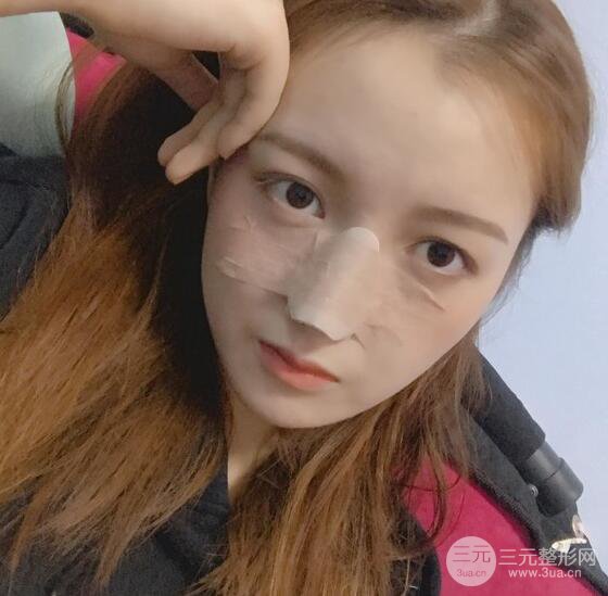 隆鼻整形多久恢復(fù)自然，模特公布隆鼻整形恢復(fù)記錄附照片