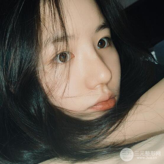 上海華美醫(yī)療美容李庭勛膨體隆鼻怎么樣？果對比圖