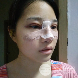 雙眼皮多項整形隆鼻整形一起做怎么樣？真人曝光果對比圖