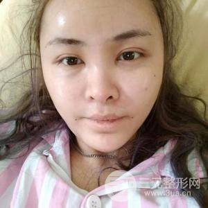 自體脂肪面部填充三個月恢復(fù)過程圖