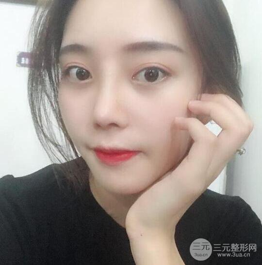 自體軟骨隆鼻恢復(fù)記錄，附對(duì)比圖片