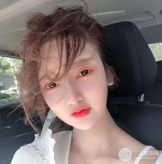 只是做了隆鼻整形改變居然辣么大，快來看看我的隆鼻整形恢復日記叭