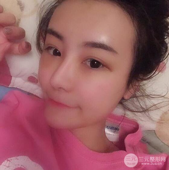 做了自體脂肪填充全臉，別人都以為我老公較為有錢