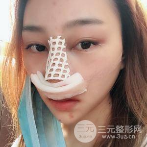 膨體大綜合隆鼻手術(shù)恢復(fù)過程圖附對比照