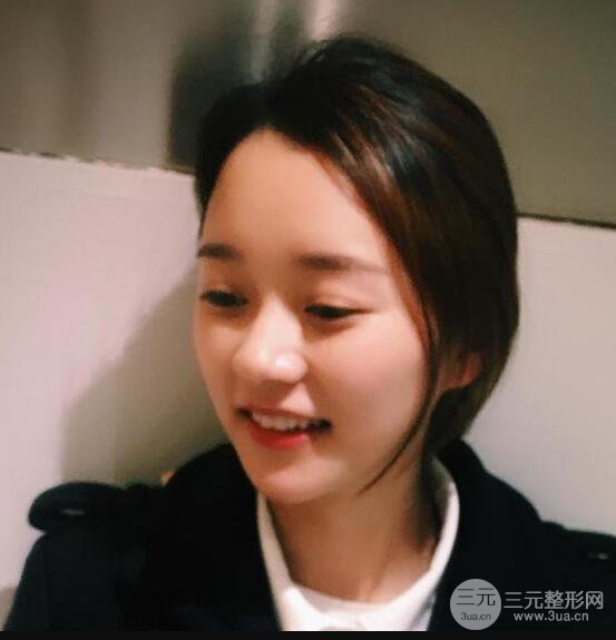 自體脂肪全臉填充三個(gè)月恢復(fù)圖，真實(shí)案例分享