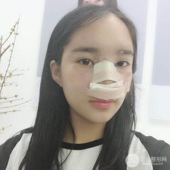 隆鼻整形術前術后對比照曝光，附經(jīng)驗分享及心得體會