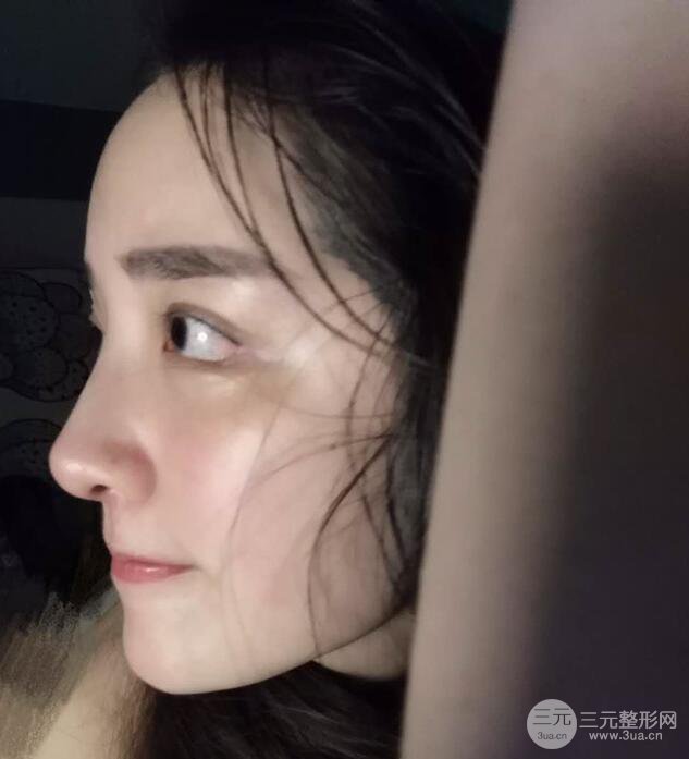 東莞寶格麗韋文奇隆鼻整形果圖分享，對(duì)比曝光