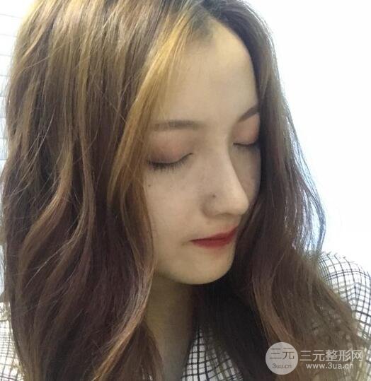 隆鼻整形多久恢復(fù)自然，模特公布隆鼻整形恢復(fù)記錄附照片