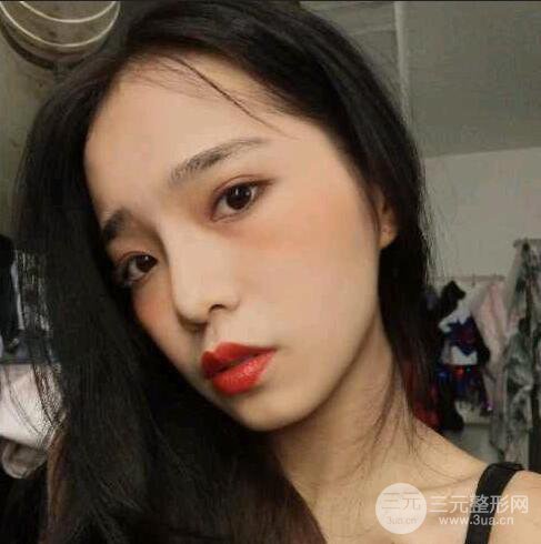 隆鼻整形術前術后對比照曝光，附經(jīng)驗分享及心得體會