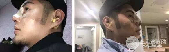 硅膠隆鼻一至7天恢復圖