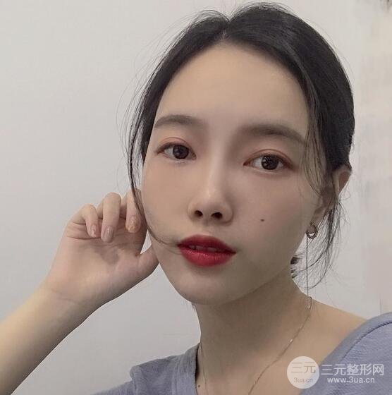 上海華美李健自體脂肪詳細(xì)部填充果圖，少女臉經(jīng)久不衰的秘密在這里