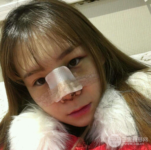 隆鼻整形三個(gè)月恢復(fù)真實(shí)圖片，做完土妹子變網(wǎng)紅辣