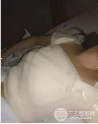 假體隆胸恢復(fù)期3個(gè)月圖片，真人日記曝光