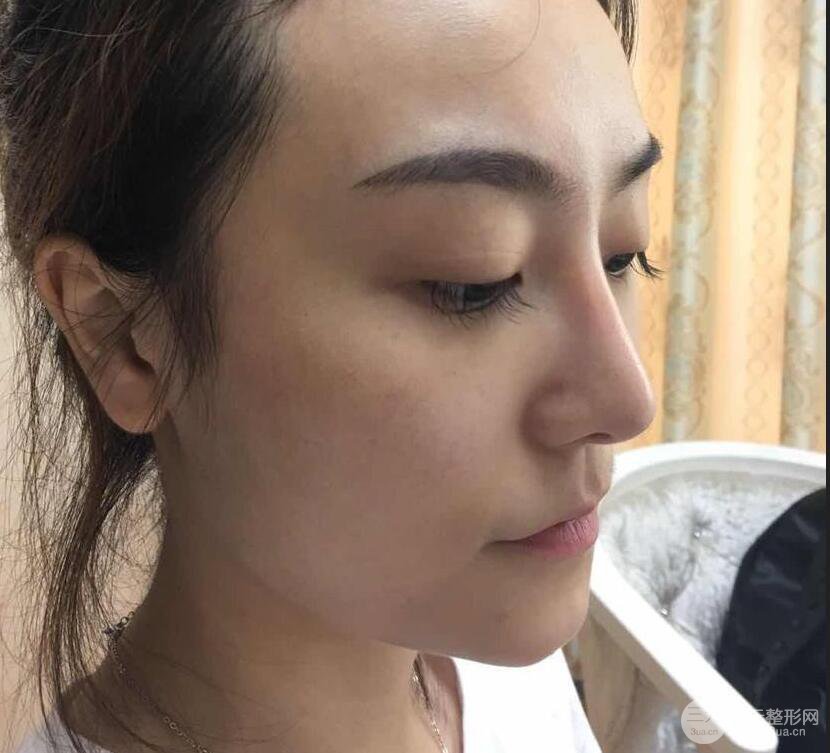 做了自體脂肪填充全臉，別人都以為我老公較為有錢