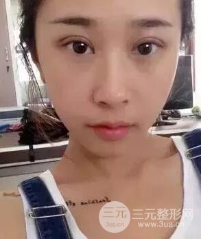切開(kāi)雙眼皮15天果圖