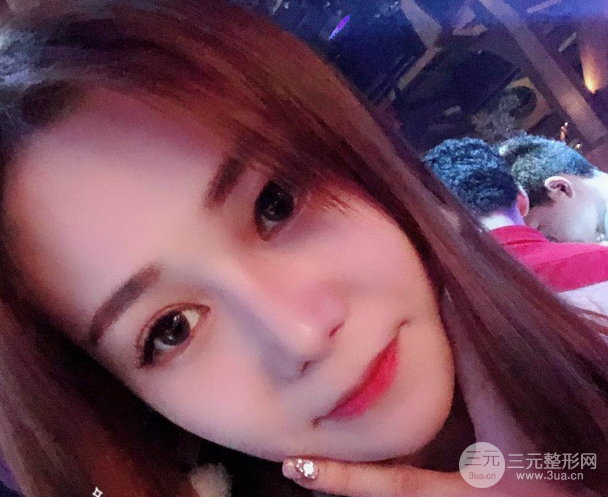 隆鼻整形三個(gè)月恢復(fù)真實(shí)圖片，做完土妹子變網(wǎng)紅辣