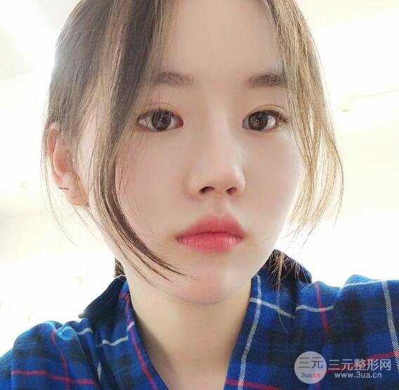 上海華美醫(yī)療美容李庭勛膨體隆鼻怎么樣？果對比圖