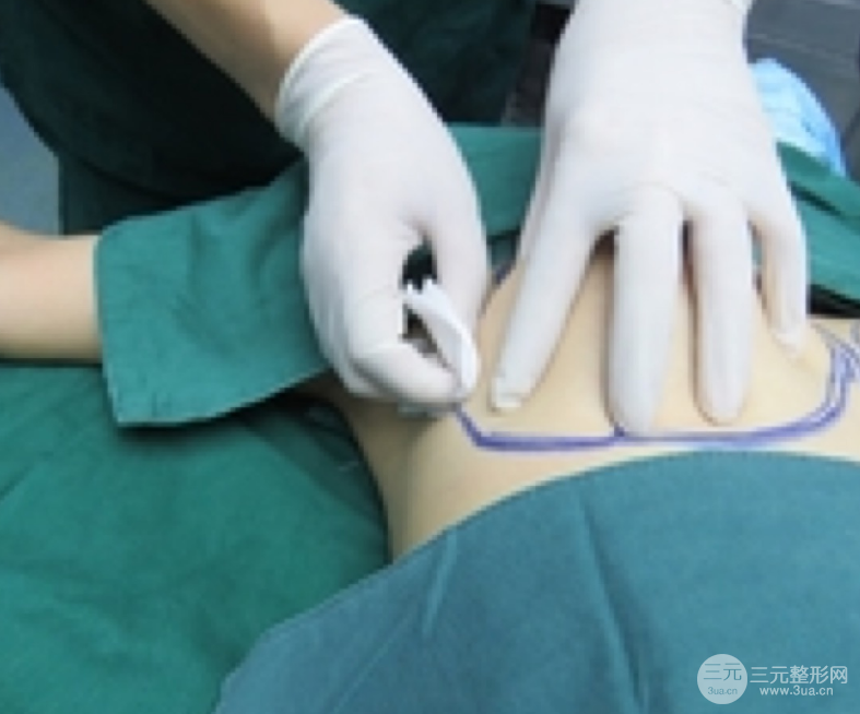 自體脂肪隆胸恢復(fù)圖曝光，見證從A到C的蛻變